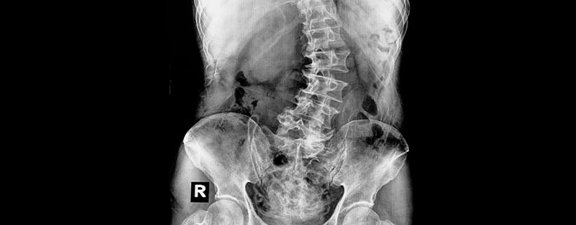 patient needing scoliosis chiropractor in El Cerrito CA